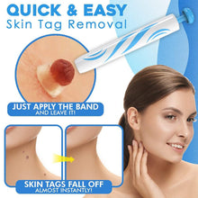 Load image into Gallery viewer, Skin Tag Removal Kit (2022)