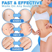 Load image into Gallery viewer, Skin Tag Removal Kit (2022)